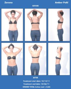 Amber Pohl's before-and-after Zerona laser body contouring results