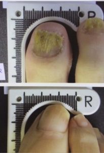 Before and after treatment images showing improvement in toenail fungus with Erchonia's Lunula Laser