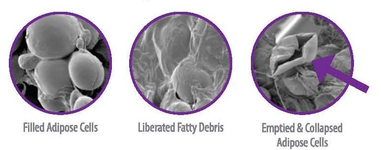 collapse of the rigid adipose cells and secretion of triglycerides and fatty acids from the cells