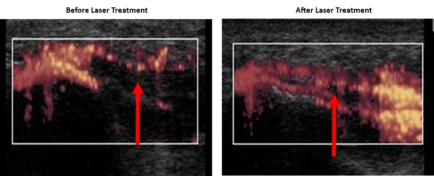 before and after laser treatment