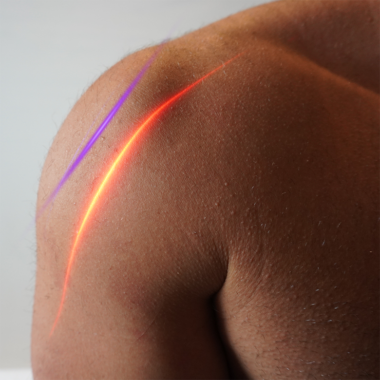 EVRL red and violet laser treatment on a person's shoulder to treat pain