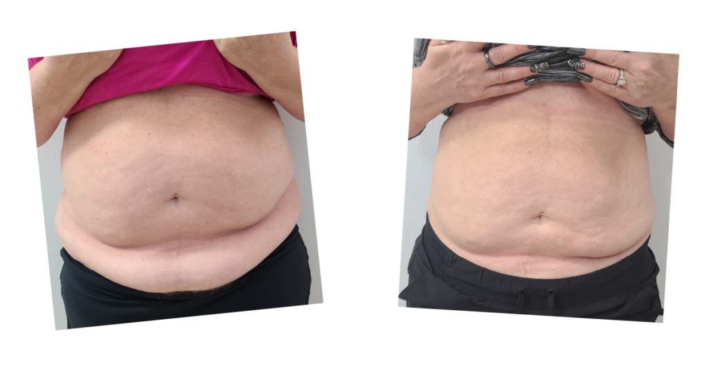 Before and after photos of fat loss on a stomach from the Emerald laser treatment