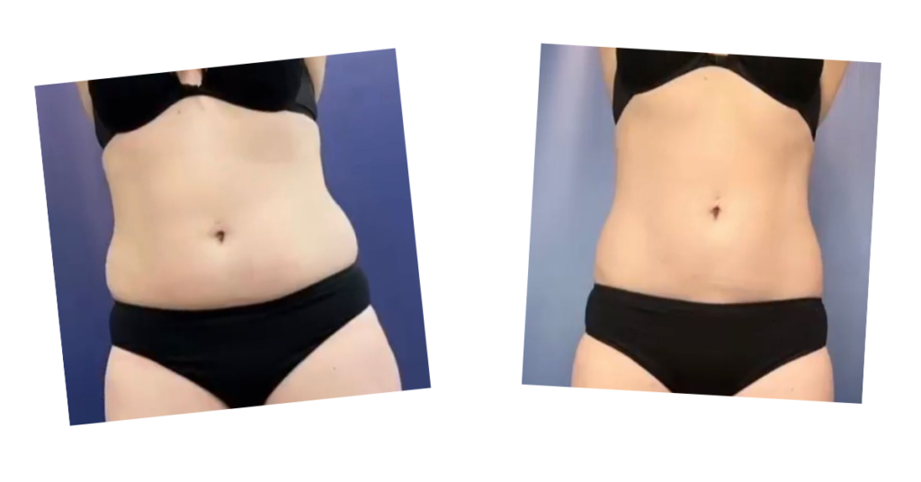 Before and after photos of fat loss on a stomach from the Emerald laser treatment