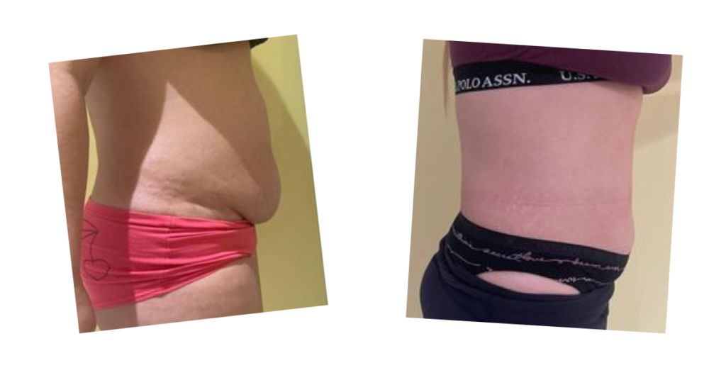 Before and after photos of fat loss on a stomach from the Emerald laser treatment