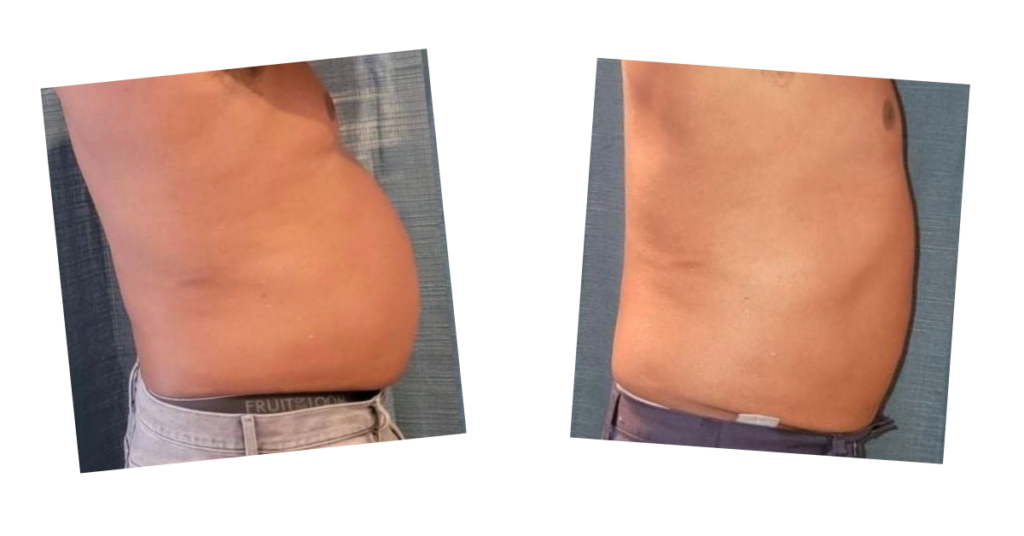 Before and after photos of fat loss on a stomach from the Emerald laser treatment