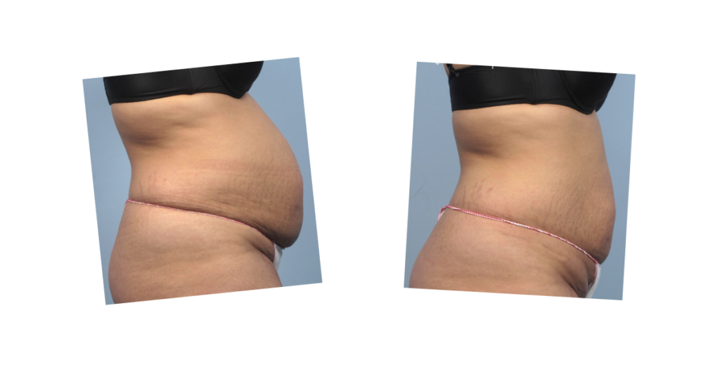 Before and after photos of fat loss on a stomach from the Emerald laser treatment