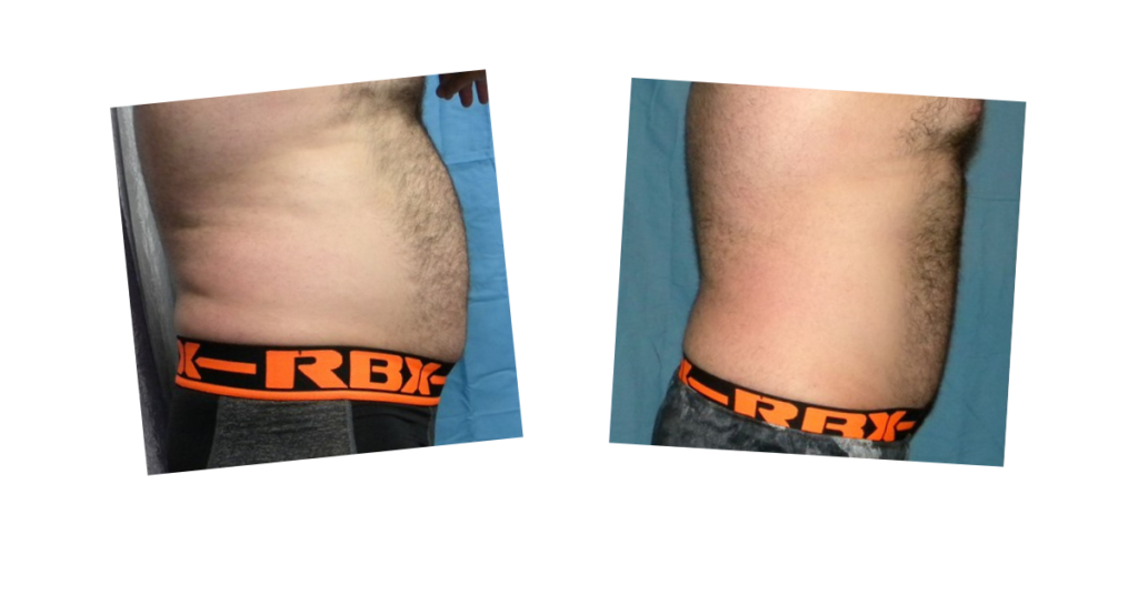 Before and after photos of fat loss on a stomach from the Emerald laser treatment