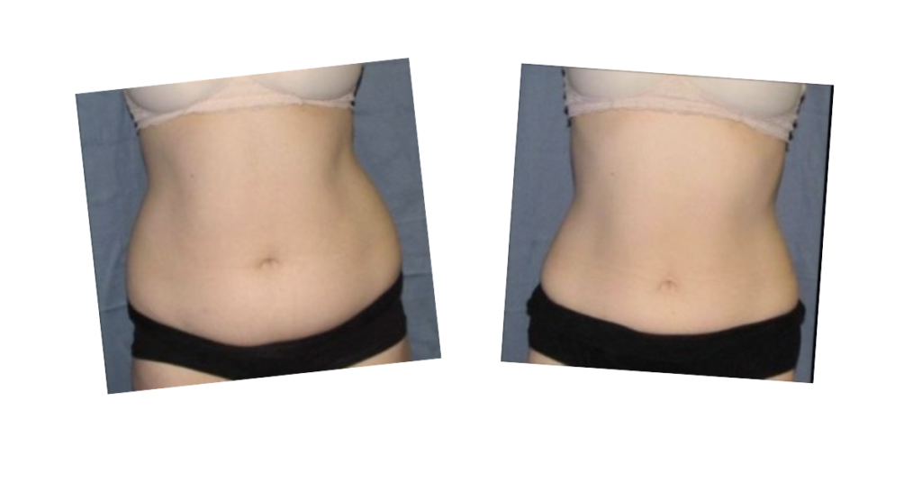 Before and after photos of fat loss on a stomach from the Emerald laser treatment