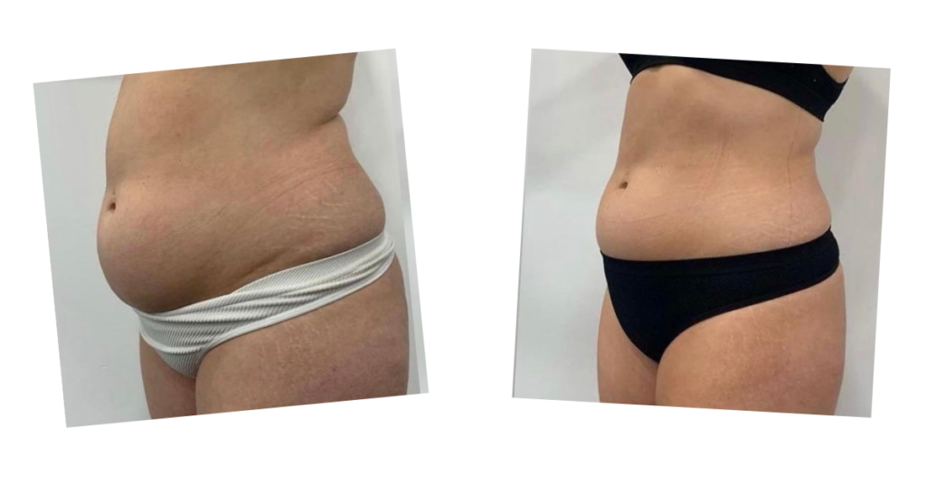 Before and after photos of fat loss on a stomach from the Emerald laser treatment