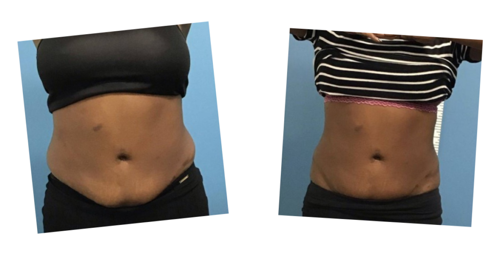 Before and after photos of fat loss on a stomach from the Emerald laser treatment