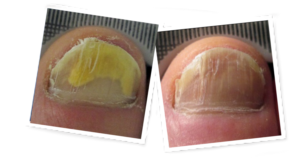 Before and after laser treatment photos of a toe with fungus