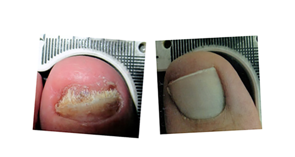 Before and after laser treatment photos of a toe with fungus