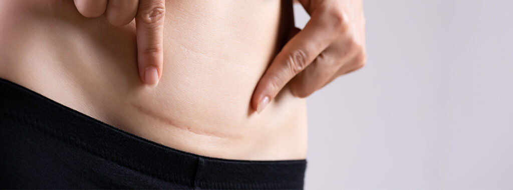 Cold Laser Therapy Benefits: Relieving Long Term Symptoms of C-Sections