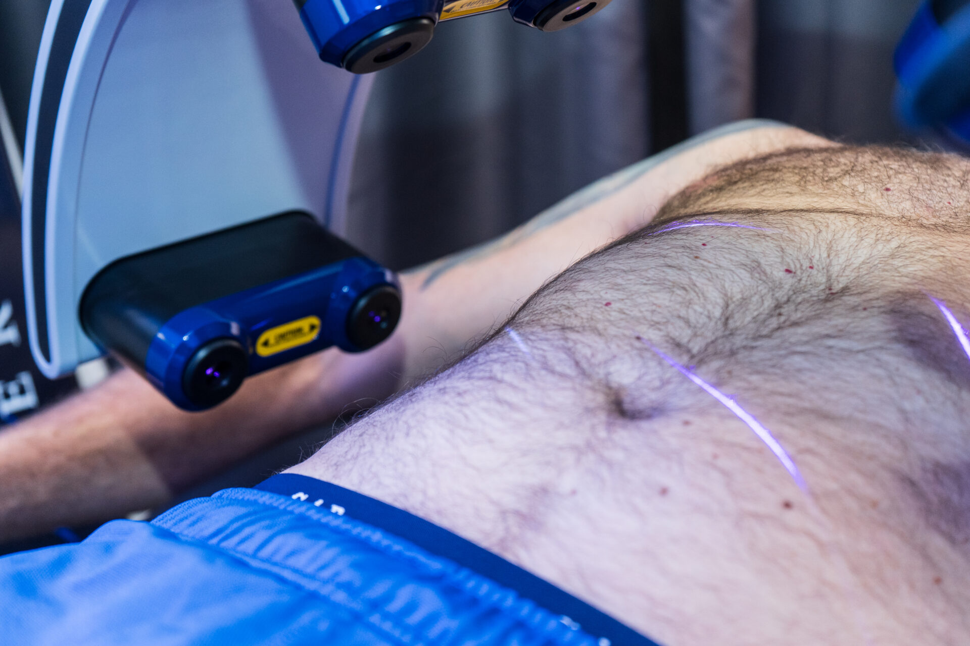 A Zerona VZ8 session on a patient’s abdomen