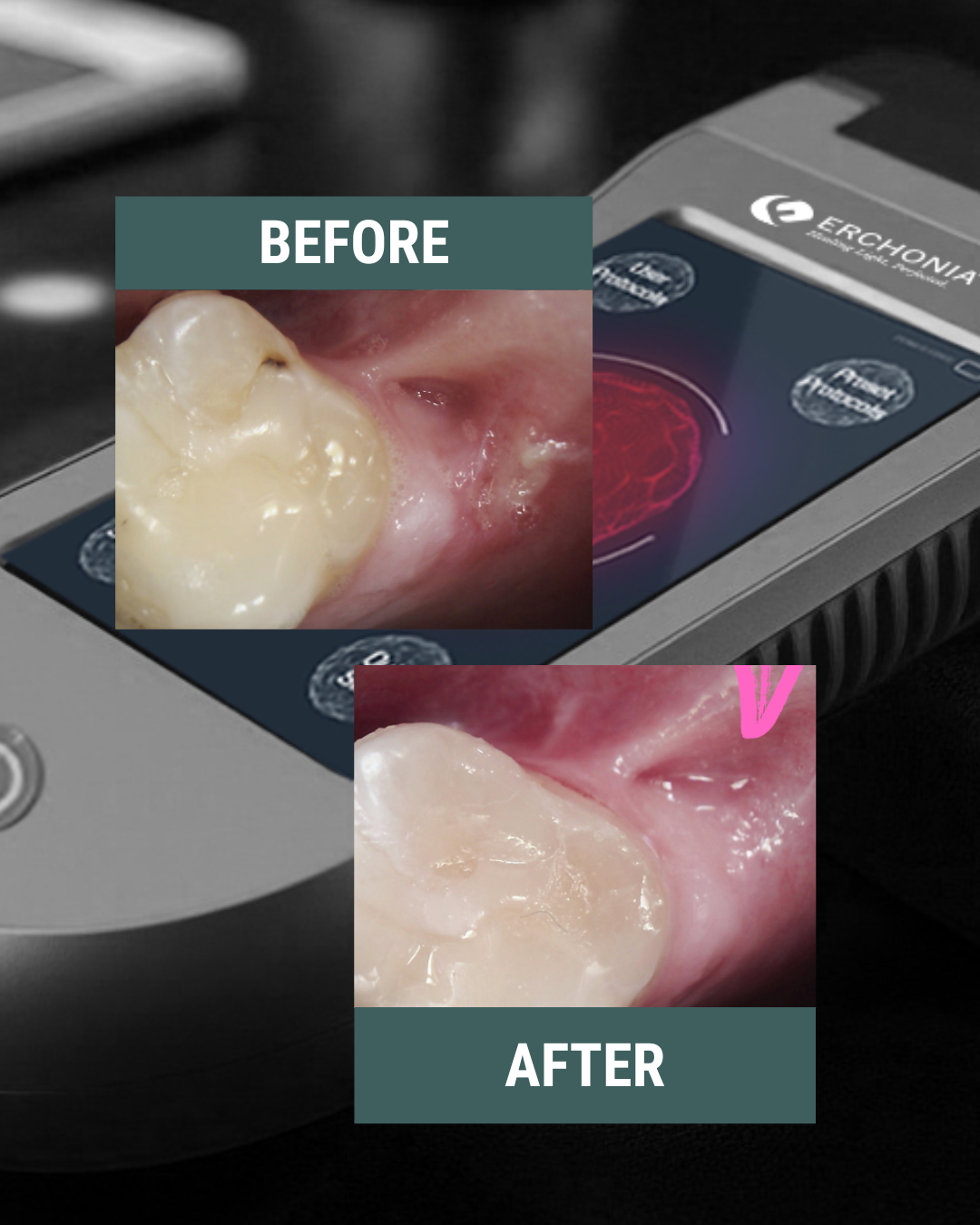 Erchonia Dental 4