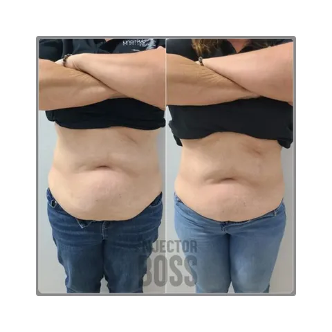 Abdomen