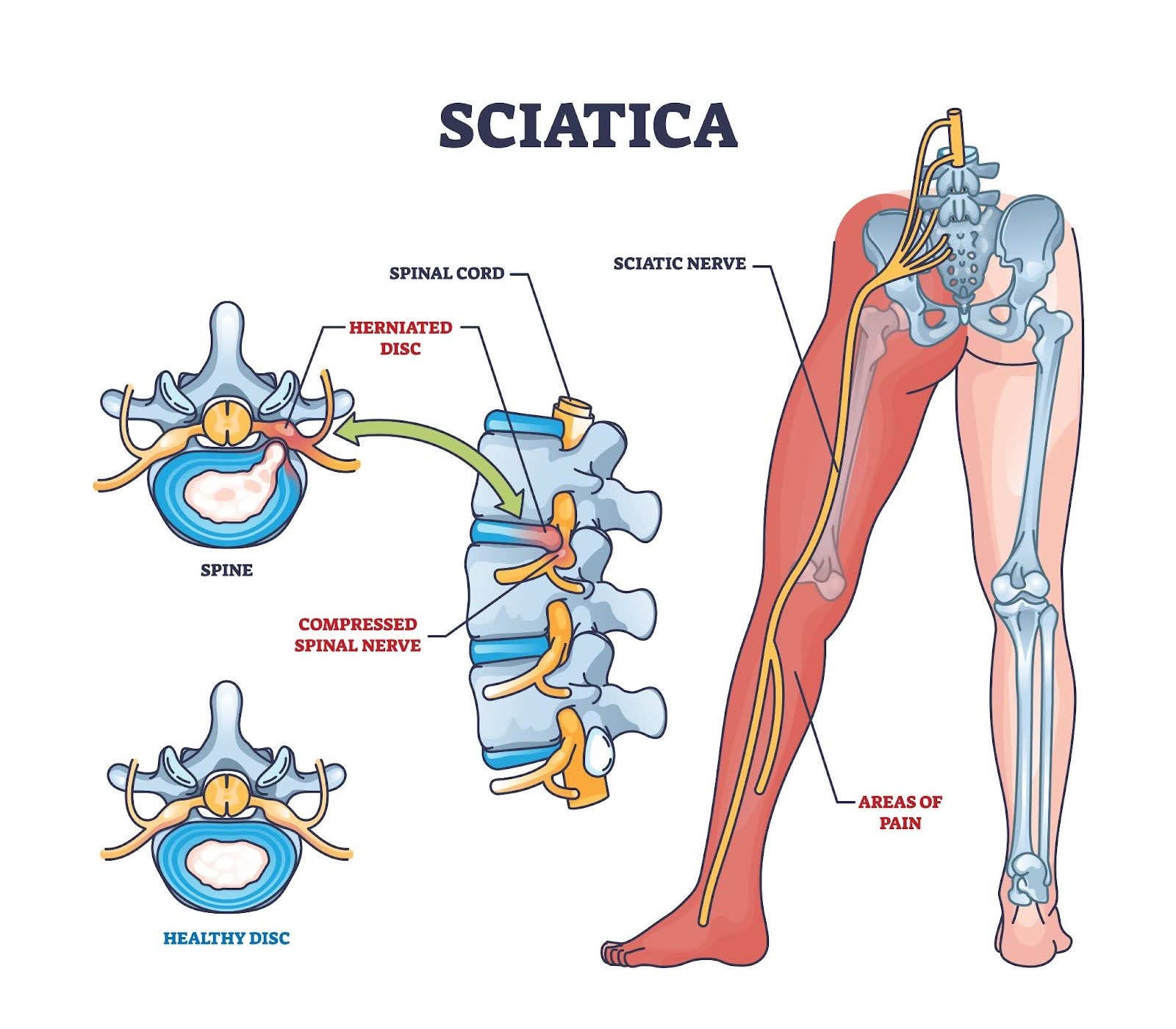 Sciatica nerve compression diagram showing herniated disc and radiating leg pain