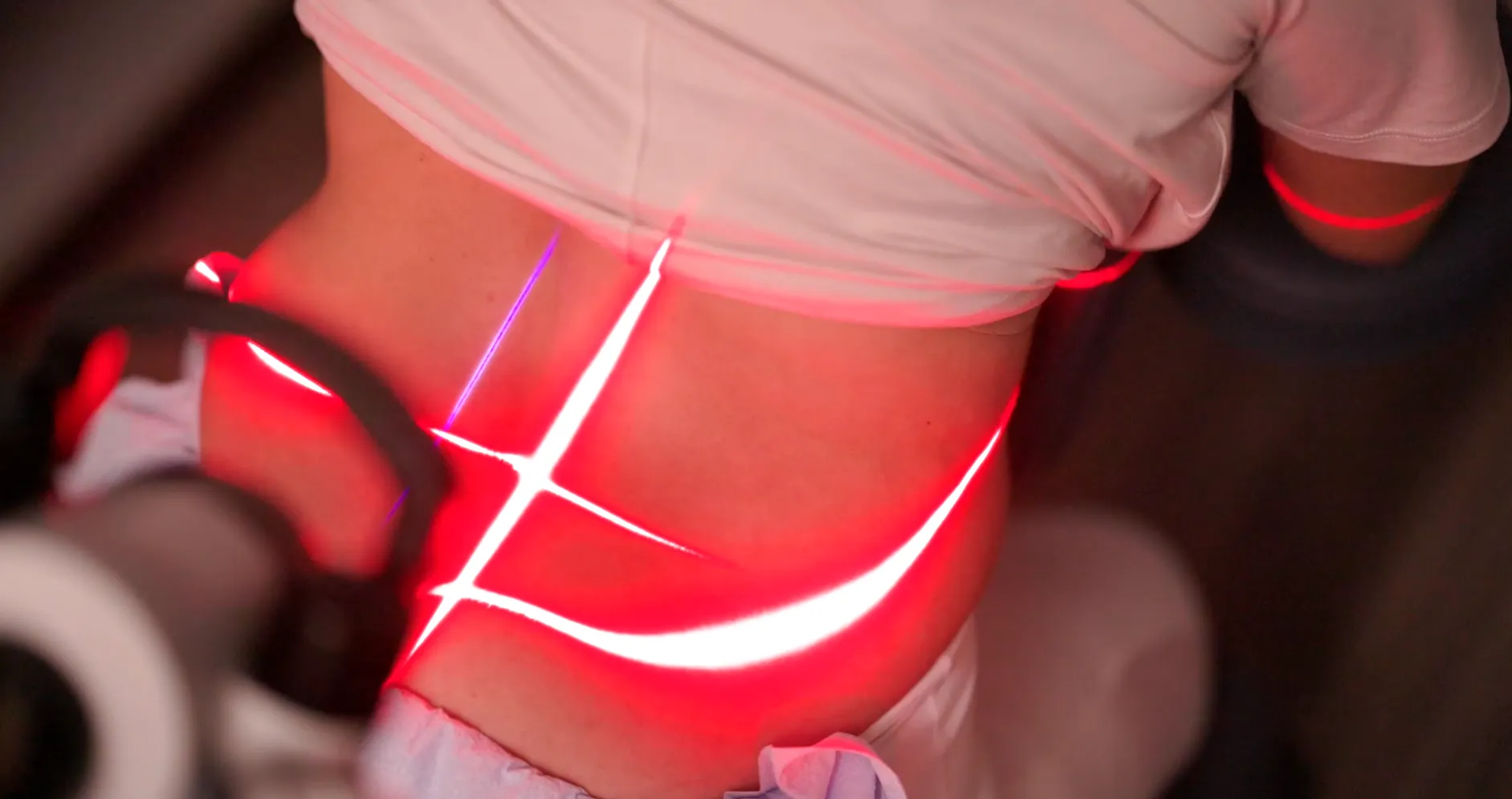Red laser lines from an FX 405 scanner across a patient’s low back