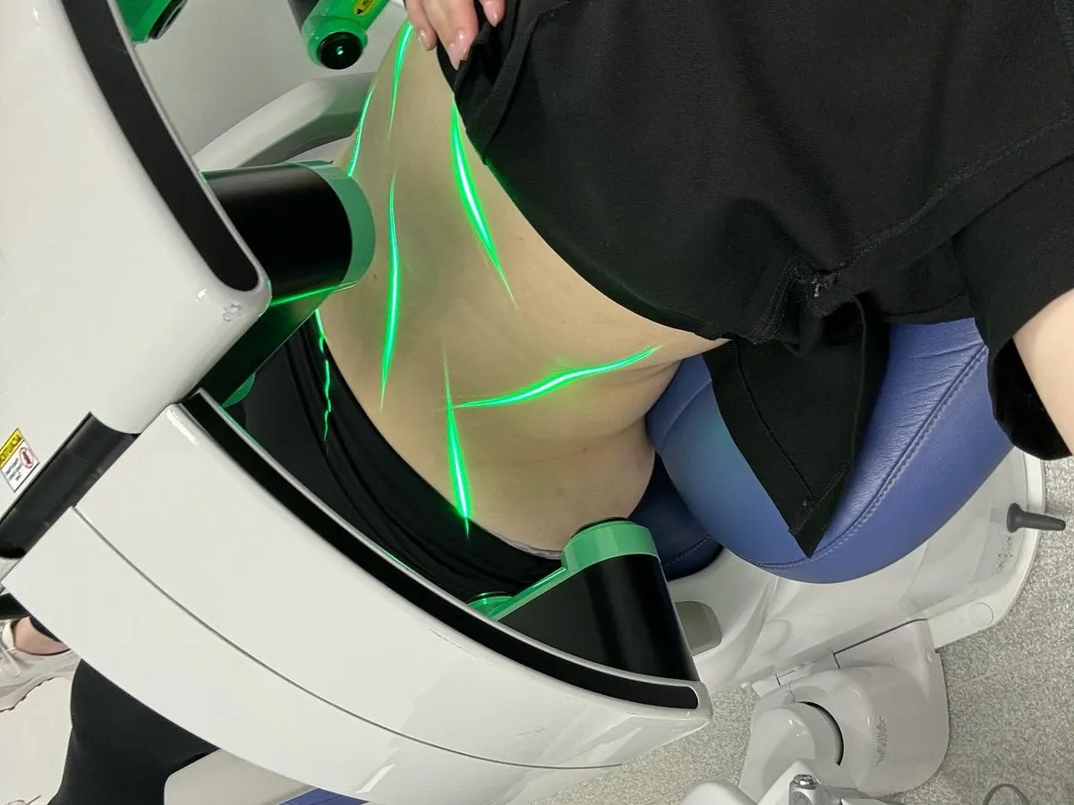 An Emerald session on a patient’s torso in an aesthetic clinic