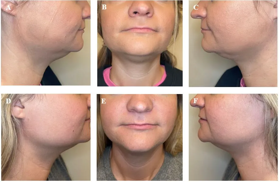 Submental · before and after